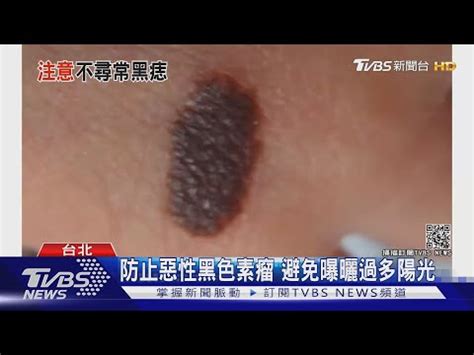 陰囊 黑痣|皮膚科王修含醫師: 男性外生殖器：皮膚病灶之診斷